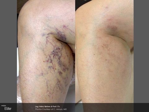 vein removal - harmony health